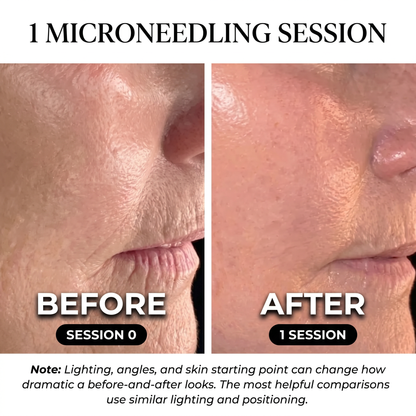 Micro Society™ 1 Year Protocol Bundle NanoNeedling